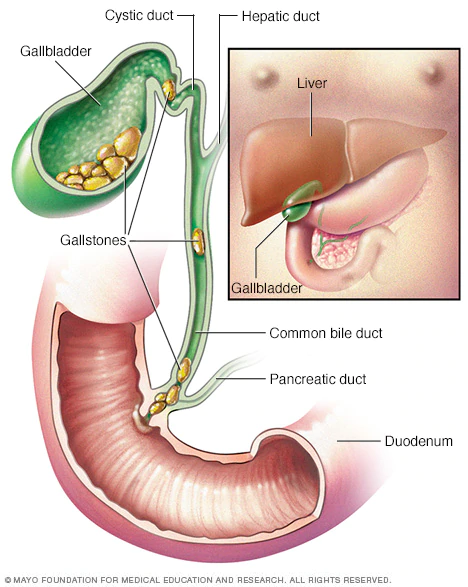   GALLSTONES