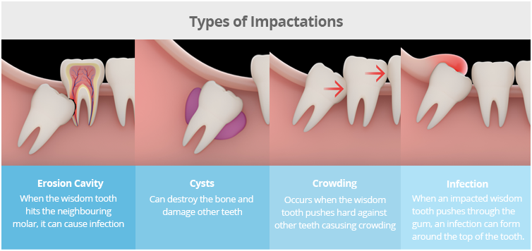 WISEDOM TEETH2