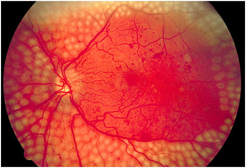 WHAT IS DIABETIC RETINOPATHY?