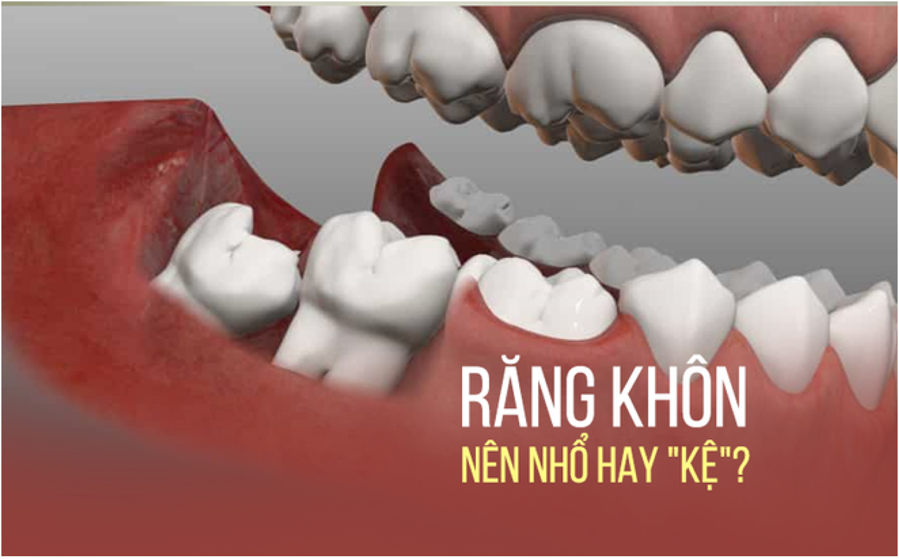 RĂNG KHÔN RĂNG DẠI2