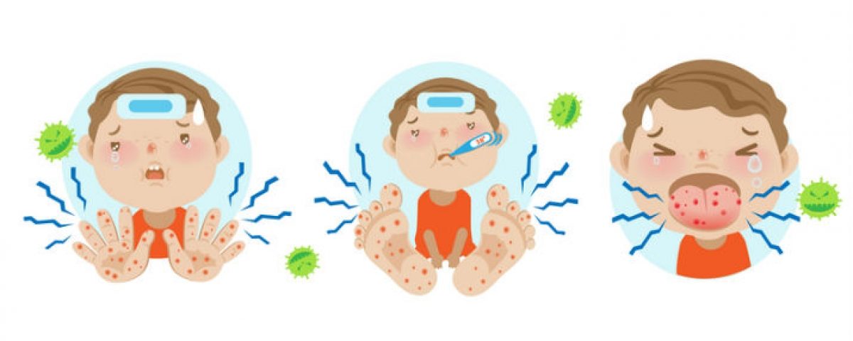 HAND, FOOT, AND MOUTH DISEASE (THE BASICS)